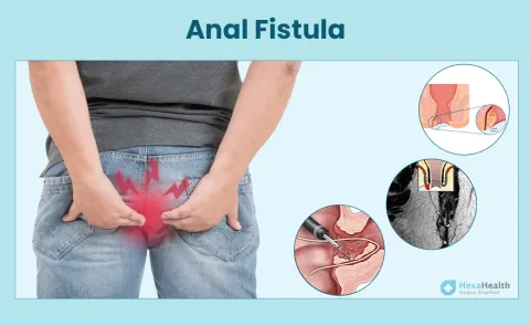 Anal Fistula: Symptoms, Causes, and Treatment